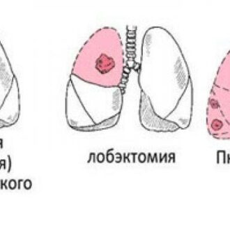 Пневмонэктомия: особенности операции