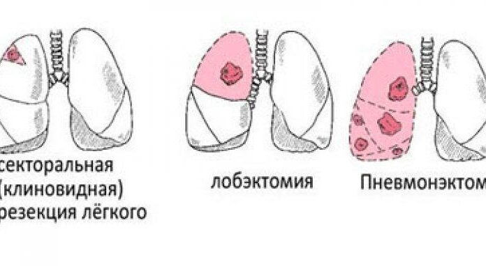Пневмонэктомия: особенности операции