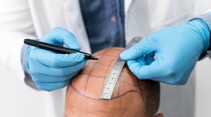 Пересадка волос: зачем она нужна и как проводится?