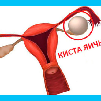 Вероятность бесплодия при кисте яичника