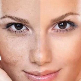 Какой эффект ждать от использования пилинга?