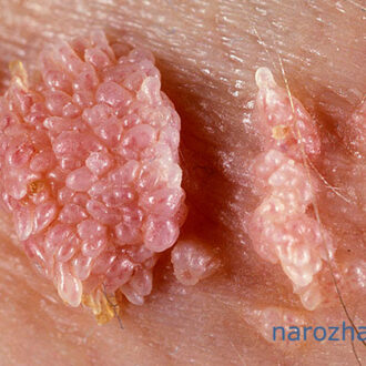 Кандиломатоз: остроконечные кондиломы у женщин! | Проблемы мужского и женского бесплодия и методы их решения