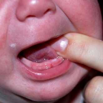 Чем облегчить боль у малыша при прорезывании зубов?