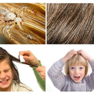 Педикулез в детском саду: действия