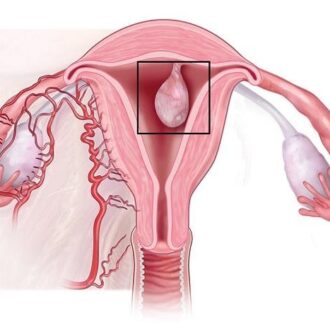Полипы эндометрия: виды полипов в матке, симптомы, диагностика, лечение
