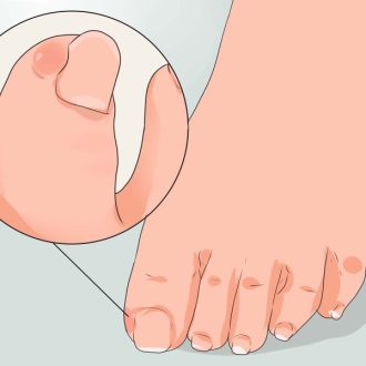 Вросшие ногти на ногах: причины