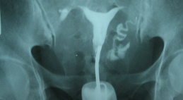 Непроходимость маточных труб у женщин: причины, признаки, симптомы, диагностика, лечение, отзывы