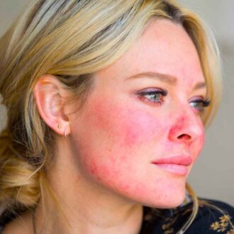 Розацеа – что это такое, чем и как лечить?