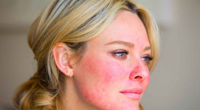 Розацеа – что это такое, чем и как лечить?