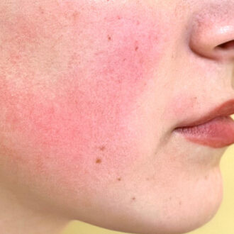 Лазерное лечение розацеа: качественная помощь при недуге