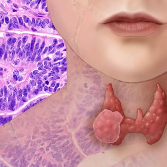 Разгадываем тайны рака щитовидной железы: от причин до лечения
