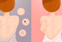 Акне на спине: ищем причину и исправляем ее