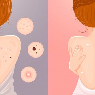 Акне на спине: ищем причину и исправляем ее