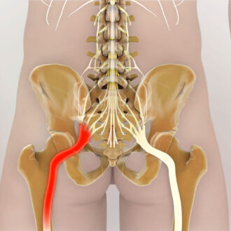 Что такое защемление седалищного нерва?