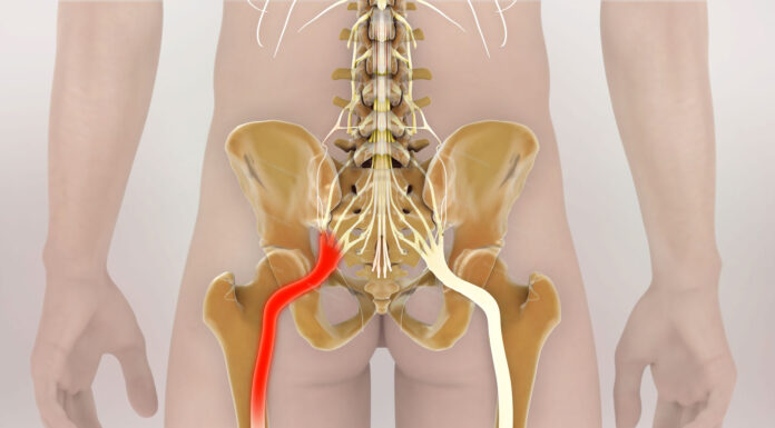 Что такое защемление седалищного нерва?