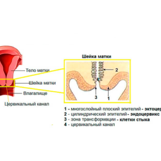 Лечение шеечного фактора бесплодия: медикаментозное и народные методы