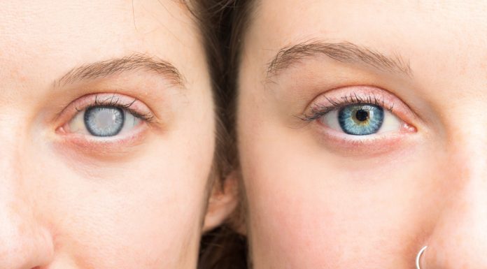 Катаракта: методы лечения патологии глаза