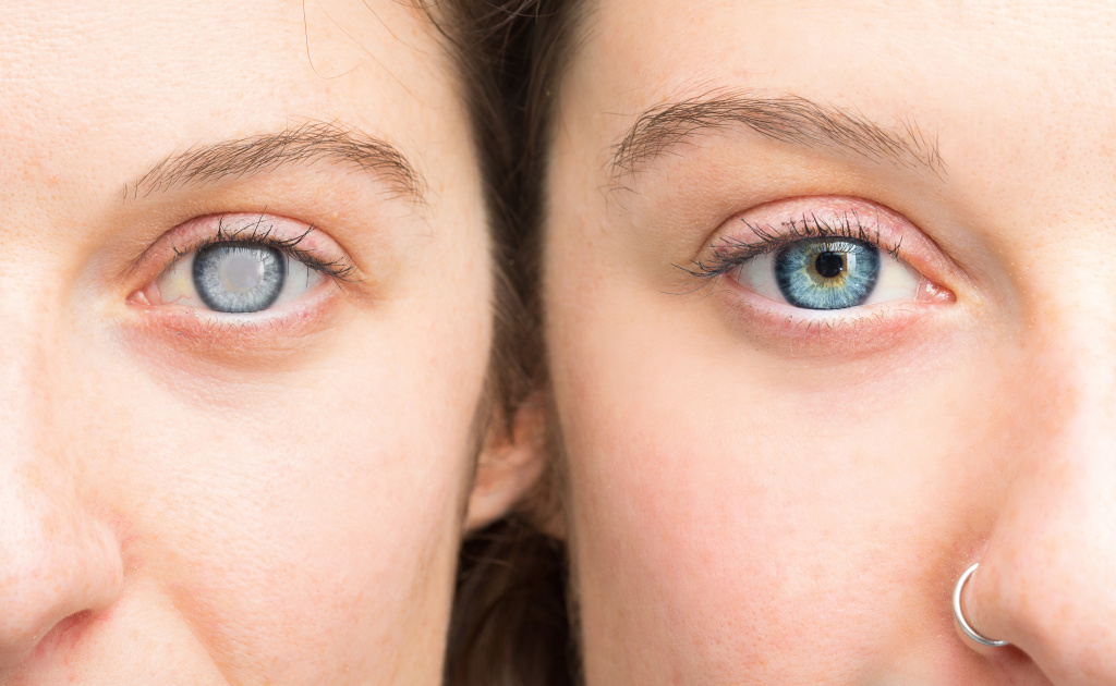 Катаракта: методы лечения патологии глаза