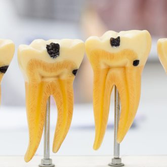 Пульпит: причины и механизм возникновения, методы лечения