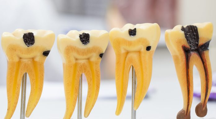 Пульпит: причины и механизм возникновения, методы лечения