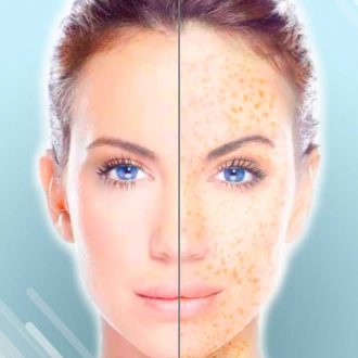 Пигментные пятна: причины появления и особенности их удаления лазером.