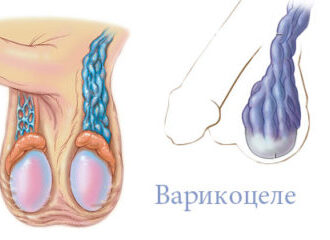 Варикоцеле и бесплодие у мужчин: можно ли иметь детей после операции, наступит ли беременность и через сколько, как болезнь влияет на зачатие