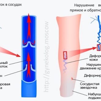 Застой крови в малом тазу — симптомы и лечение у женщин