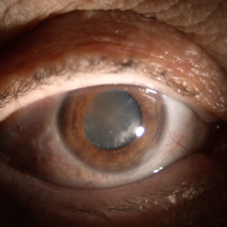 Операция по удалению катаракты: что важно знать