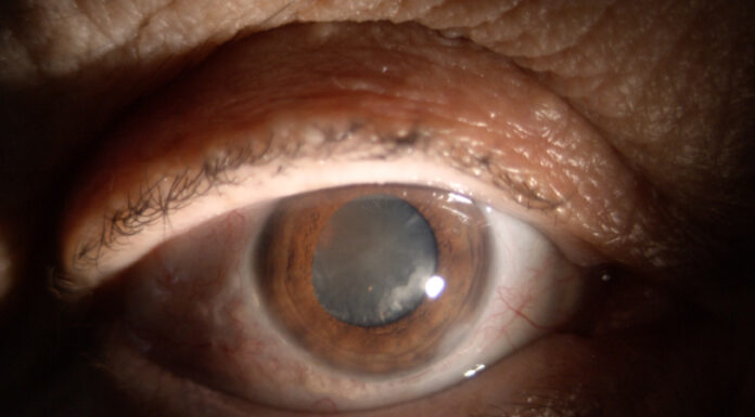 Операция по удалению катаракты: что важно знать