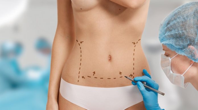 Избавьтесь от последствий родов с помощью абдоминопластики: восстановление живота после беременности